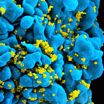 Das Bild zeigt eine Darstellung einer mit HIV infizierten T-Zelle